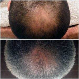 Oberkopf eines Mannes, der an Haarausfall leidet mit Vergleichsbild eine Microneedling Behandlung und dem Ergebnis davon.