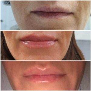 Vorher Nachher Bilder von schönen, volle Lippen die nach der Microneedling Behandlung voluminöser sind.